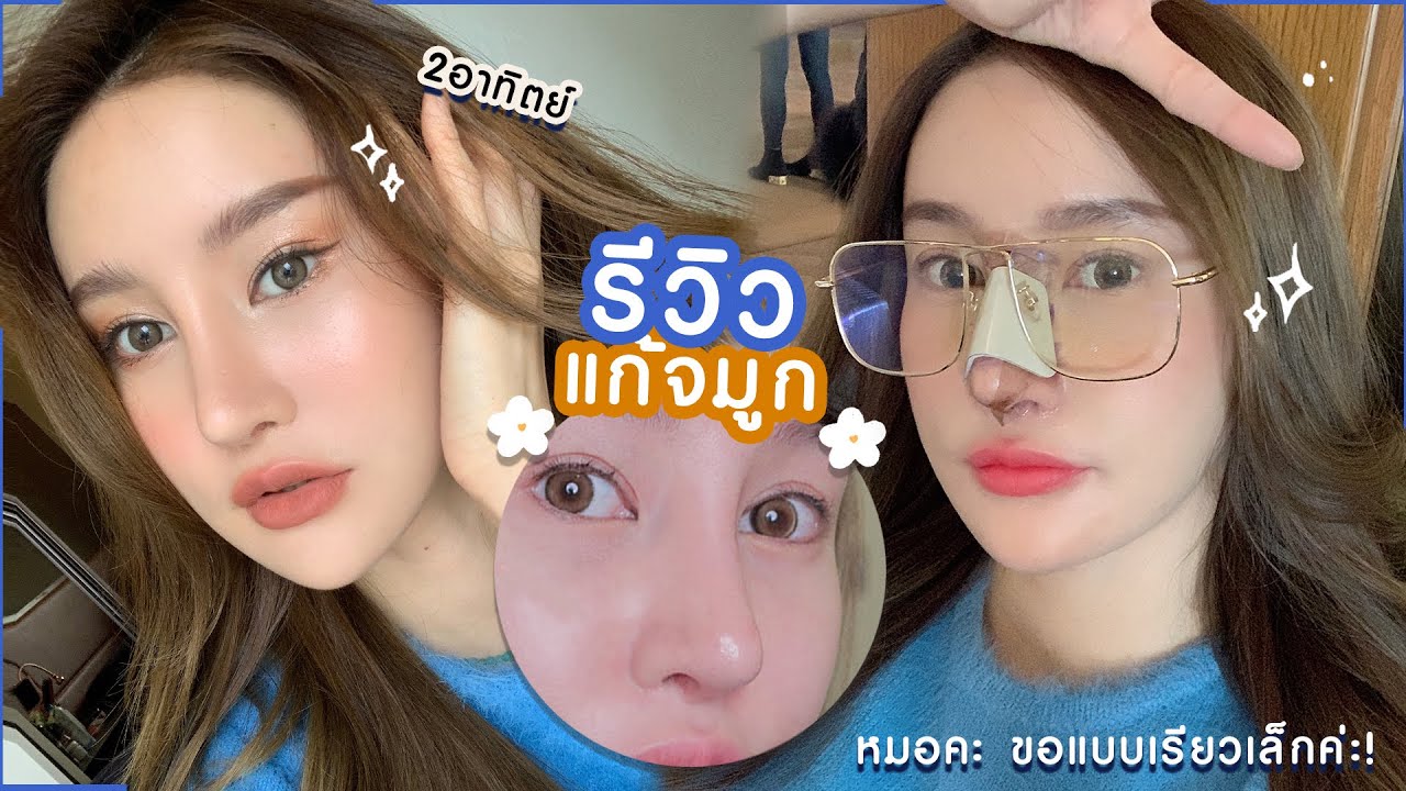 เสริม จมูก ทรง เกาหลี  2022  SURGERY VLOG รีวิวแก้จมูกแบบเรียวเล็ก ทำที่ไหน ทรงอะไร? Piyapeauty