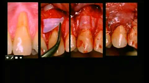Tissue Engineered Solutions for Esthetic Dilemmas - Part II (2008)