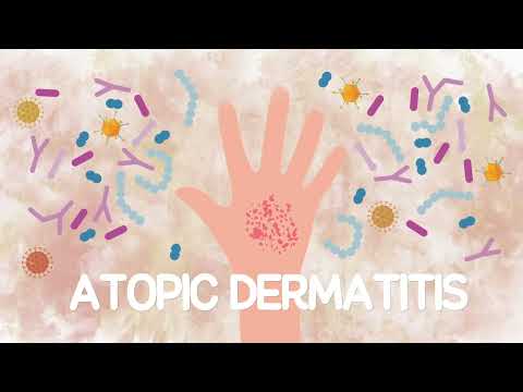 Video: Dermatitis atopik