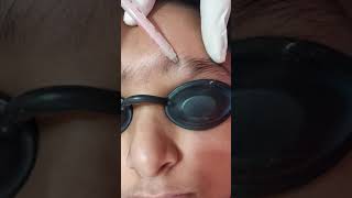 Eyebrow hair growth. Dr Deepak Mohana MD