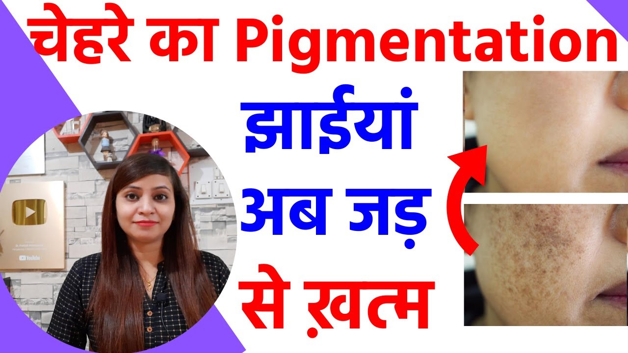 चेहरे की झाइयां ख़त्म करने का तरीका, melasma ka gharelu ilaj