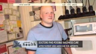 Doctors Find Possible Cure For Baldness