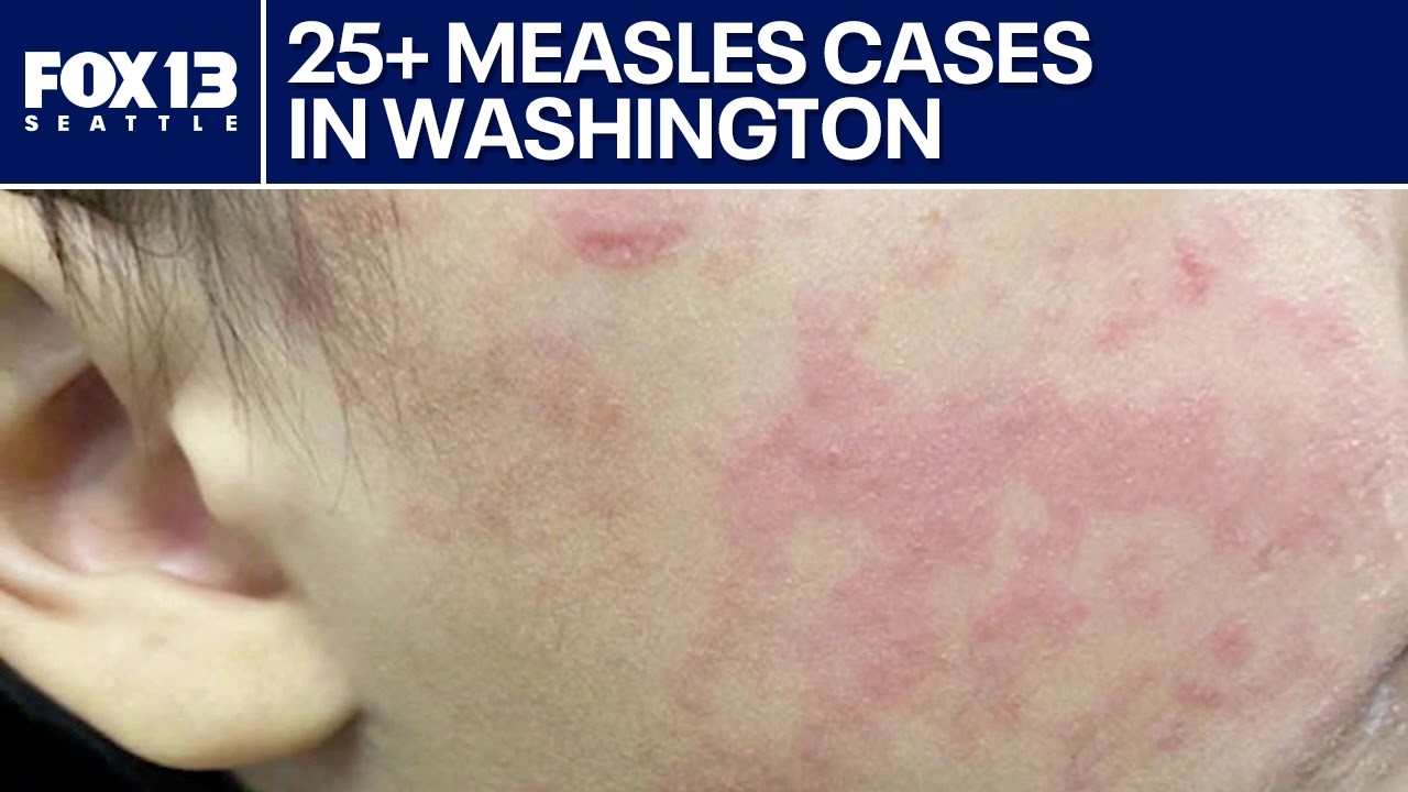 Measles cases spike in Washington, across U.S. | FOX 13 Seattle