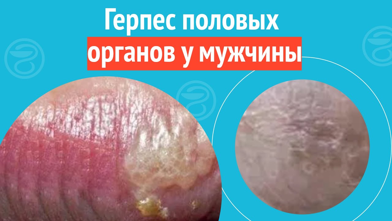 🫤 Герпес половых органов у мужчины. Клинический случай №1226 - YouTube