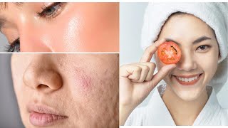 How to get rid of open pores | 3 Days & all open pores will disappear on your skin FOREVER