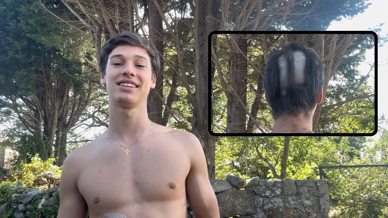 accidentally went bald