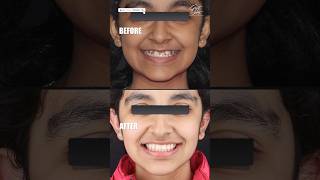 Braces Transformation | Braces Journey | Braces Before and After | Alignment of Teeth Without Braces