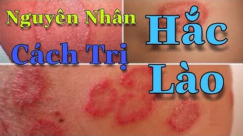 Hắc lào Nguyên nhân gây ra và cách điều trị tận gốc