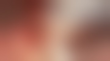 Root coverage with coronally advanced flap without grafting.