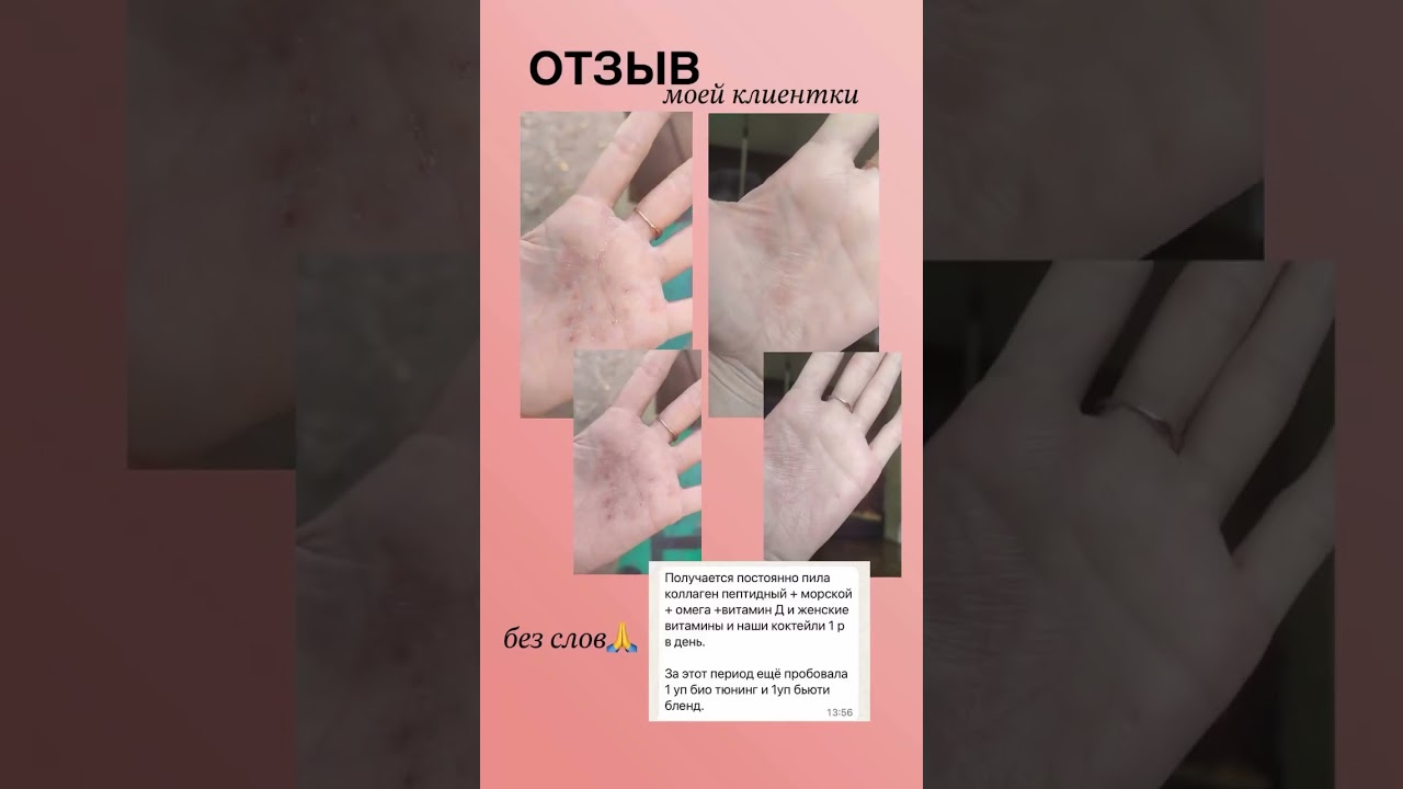 Экзема , дерматит, как помочь