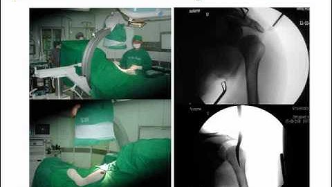 Closed Antegrade Humeral Nailing for Distal-Third Humeral Shaft Fracture