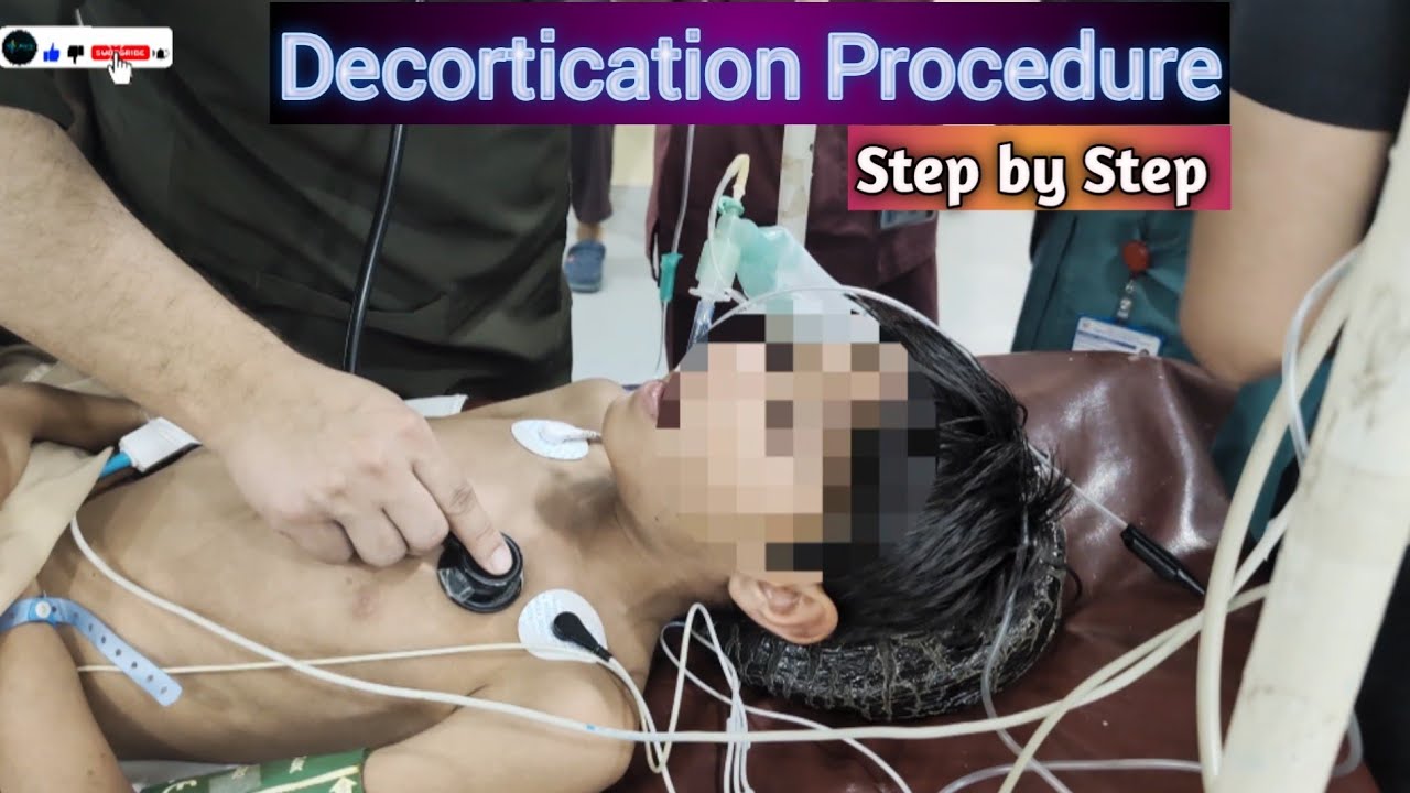 Decocation Process Decortication Procedure Step by Step | Thoracic Procedure Explained ...