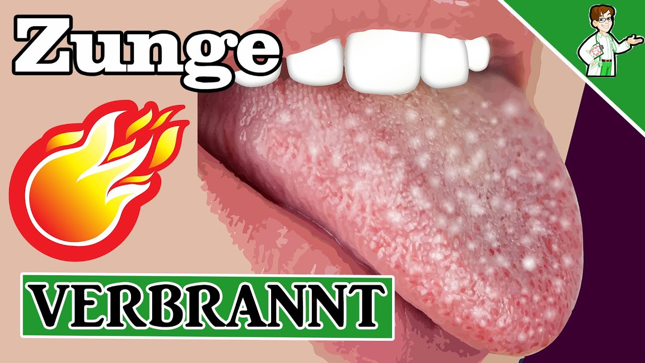 Zunge Verschluckt Wie Sieht Das Aus Zunge verbrannt - Diese 10 Tipps helfen schnell und zuverlässig 🔥 - YouTube