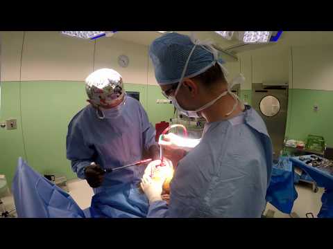 Wideo: Chirurgia Rewizyjna Wymiany Kolana: Co Musisz Wiedzieć