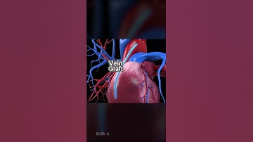 Double Bypass Heart Surgery #3danimation  #healthcare #heart