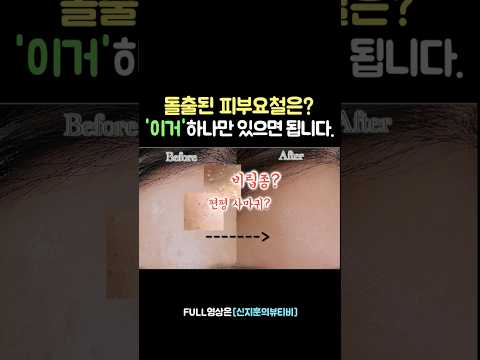 프라이머 효과없어요!!!❌피부요철에는 ‘이게’ 직빵이에요‼️#피부요철#컨실러추천#프라이머#비립종#모공커버#편평사마귀#피부화장#피부요철#프라이머사용법#펜슬컨실러#shorts