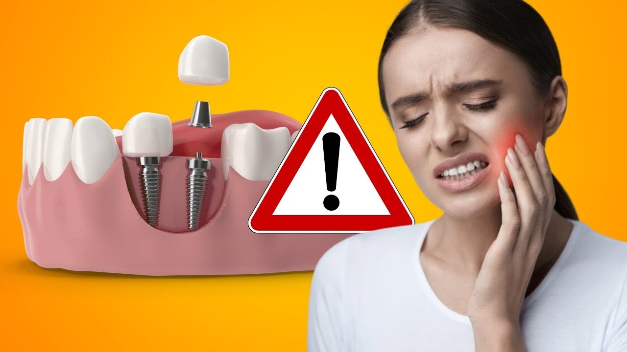 Outline Video EVERYONE WANTS TO KNOW: Will Dental Implants Hurt?