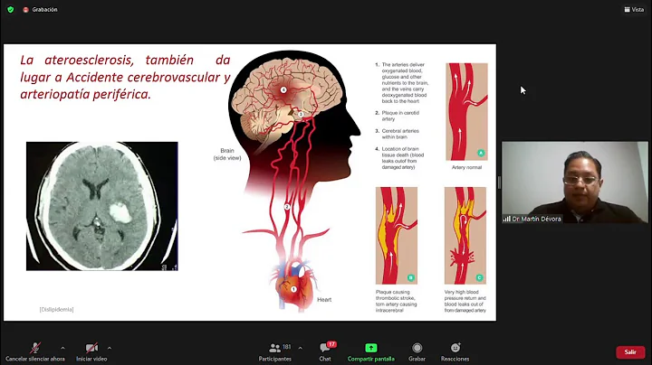 Dislipidemia - Dr.  Martn Devora