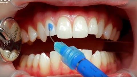 Quy trình gắn khay niềng răng invisalign trong suốt