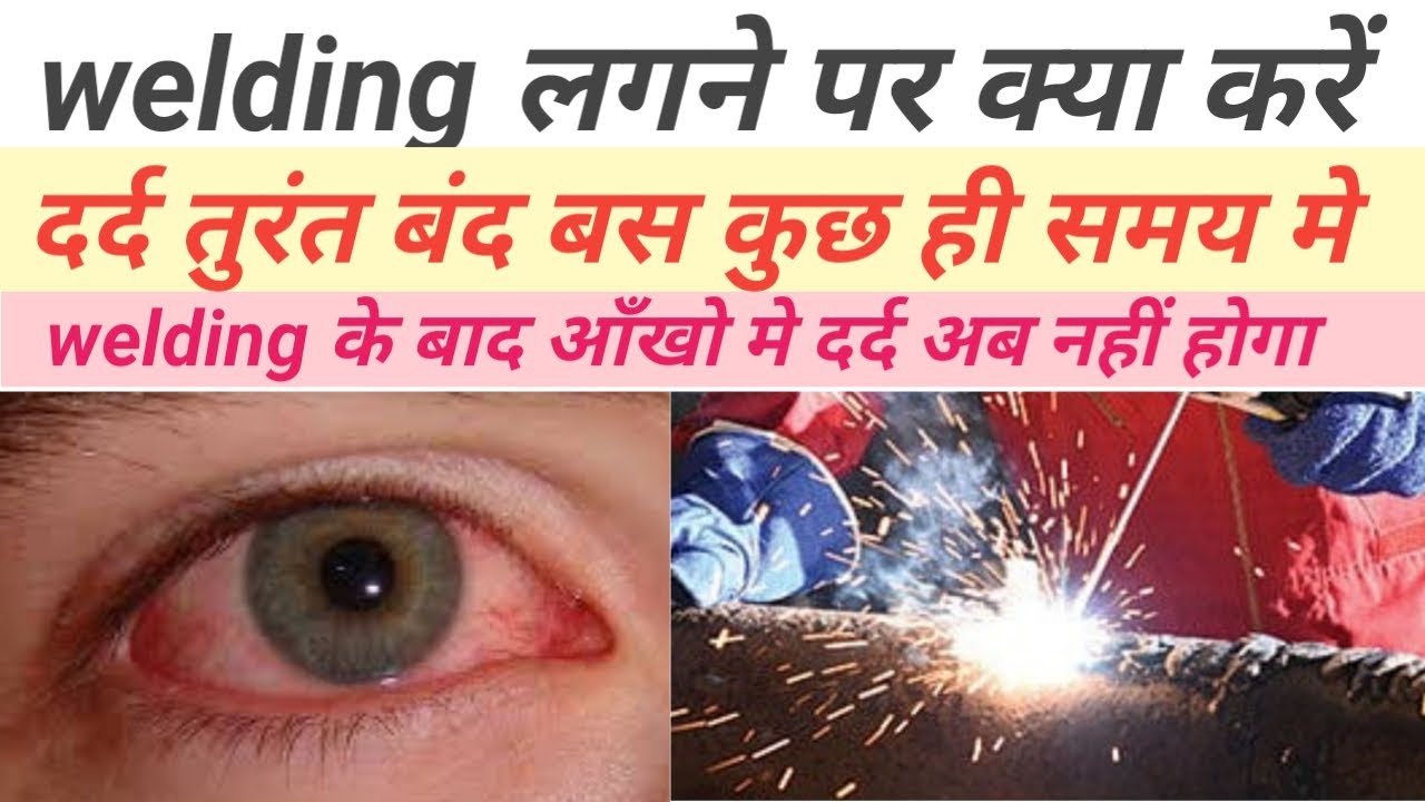 welding flash eyes weling pain /welding lagne par kya kare YouTube