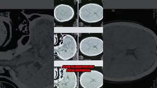 Alice In Wonderland Syndrome - The Mind Bending Condition Alice In Wonderland Syndrome - The Mind Bending Condition
