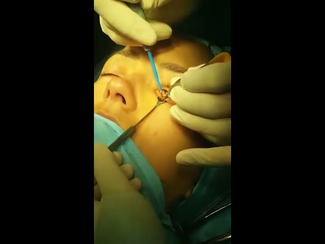 Нижняя трансконъюнктивальная блефаропластика