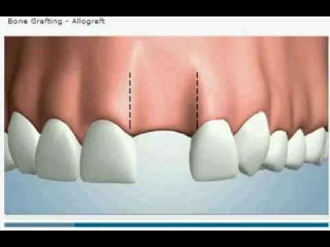 Video: Forskellen Mellem Basal Knogle Og Alveolær Knogle