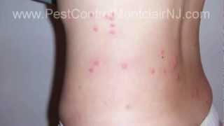 Pest Control: Bed Bug Montclair NJ