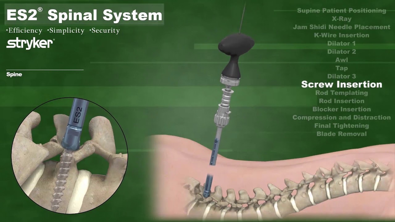 ES2 Spinal System Stryker 2021 YouTube