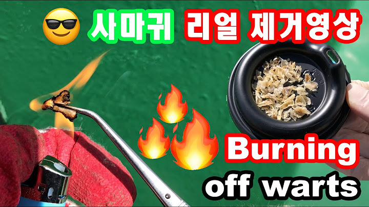 SUB) 불로 사마귀 지지고 태우기 - 사마귀에게 받은만큼 돌려줘야겠죠?