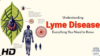 Lyme Disease Myths Busted: Facts You Shouldn't Ignore