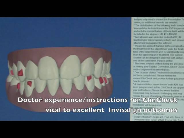 invisalign informative explanation clincheck
