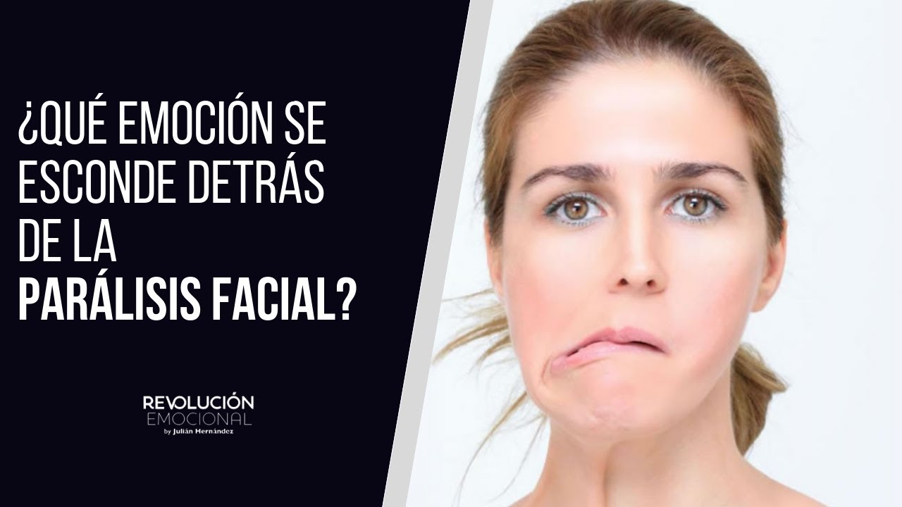 Se puede hacer vida normal con paralisis facial