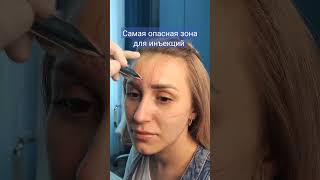 Межбровье - самая опасная зона для инъекций.