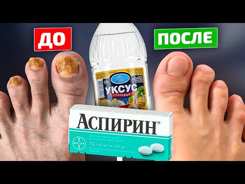 Тайное оружие фармацевтов от грибка ногтей! Уксус и аспирин