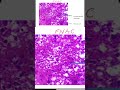 PAPILLARY THYROID CARCINOMA - 02 #neetpg #neetss2026 #pathology