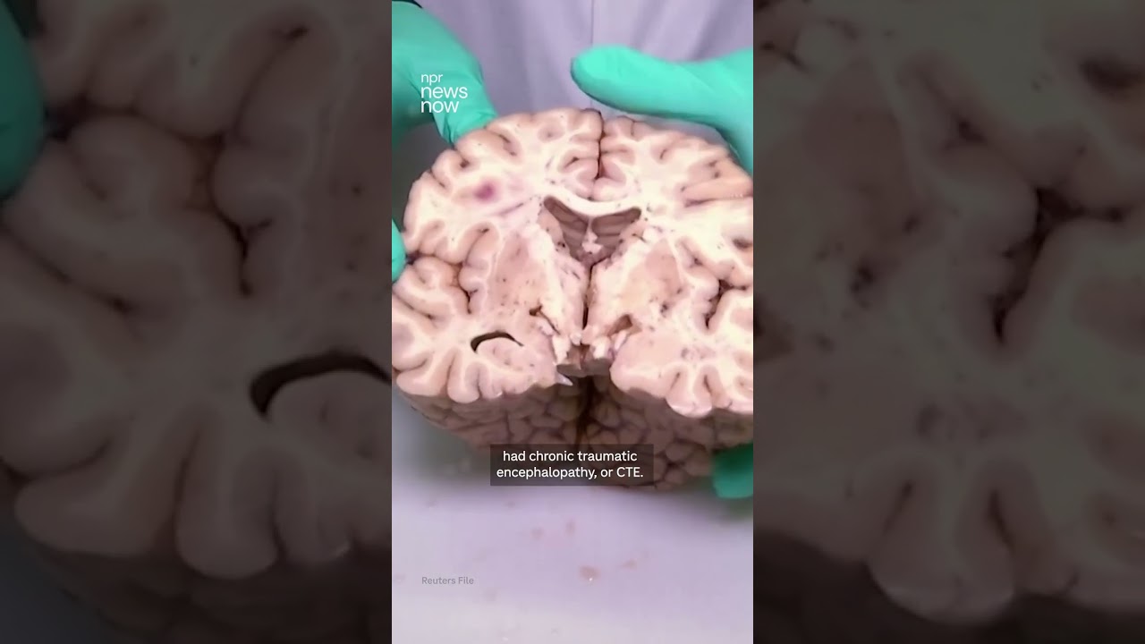 New study finds CTE in at least 25% of former NFL players
