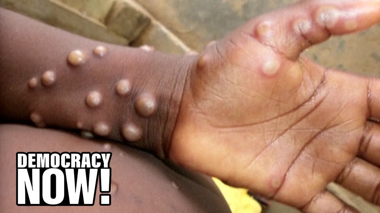 “Immense Frustration”: Monkeypox Spreads Amid Slow US Response; WHO Declares Emergency – Democracy Now!