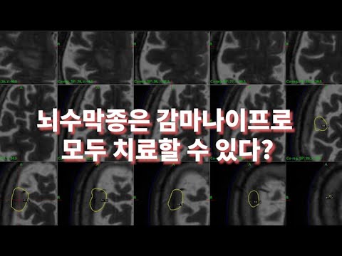 감마나이프로 뇌수막종을 모두 치료한다? ㅣ뇌수막종 ep.4 [의알남]