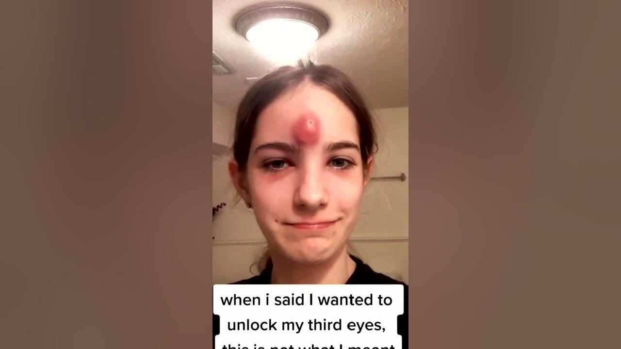 Pimple squeeze face Pimples treatment by doctor YouTube