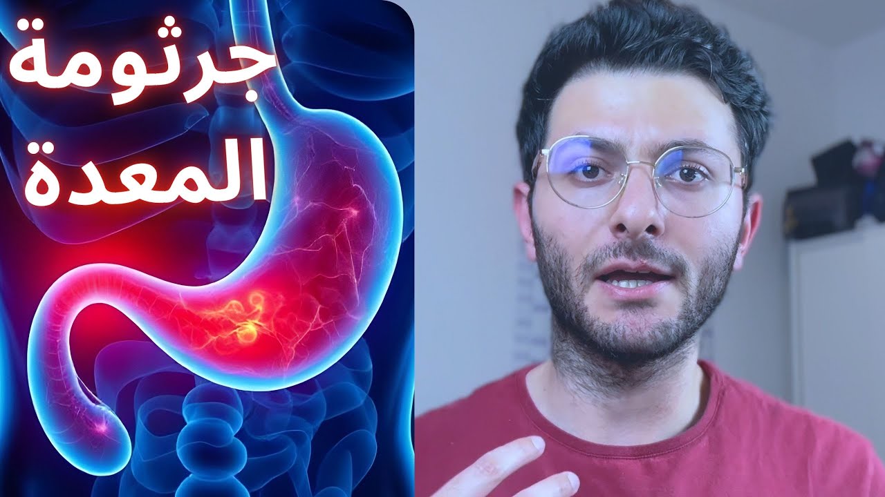 علاج جرثومة المعدة | سبب القرحة! أعراض وعلاج نهائي مع أهم طرق الوقاية! Helicobacter Pylori