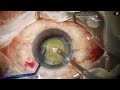 Management of a hypermature morgagnian cataract by direct chop pradip mohanta 30th march 2024
