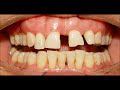 Orthodontic Treatment of Severe Median Diastema, Ekhlas 37yrs