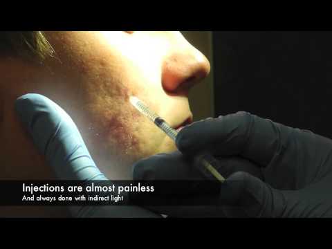 Corticosteroid injection for acne cyst