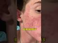 Elimina el acné hormonal #skincare #skincareroutine #glowup #glowingskin