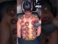 Fire Cupping Therapy – Cup Removal Process