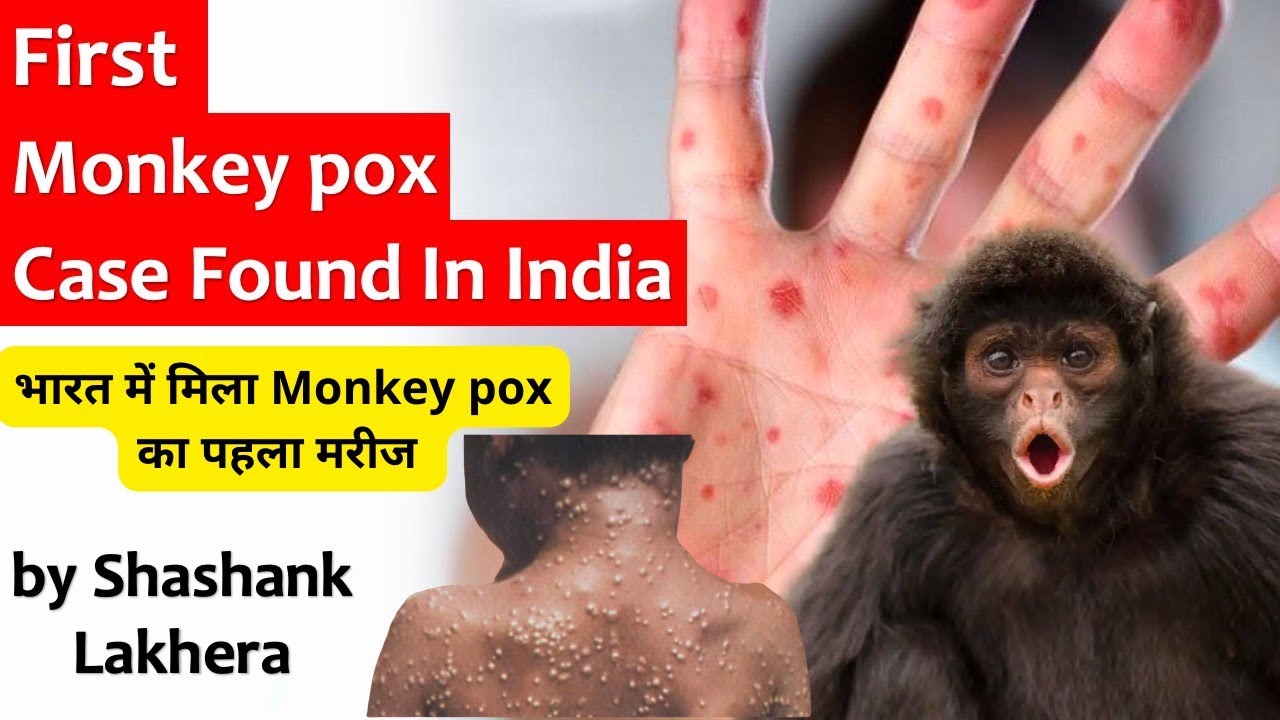 High Alert In India l India's first Monkeypox case reported In Kerala ...