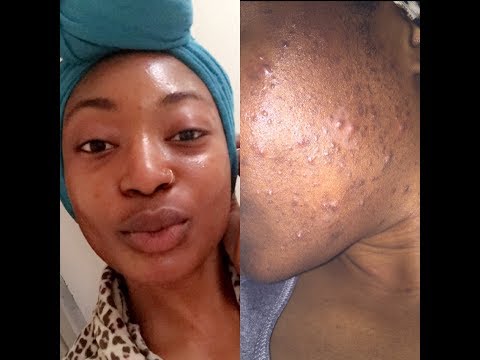 my-natural-skin-care-products-||-how-i-cleared-my-severe-acne