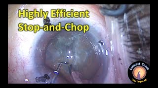 highly efficient stop and chop cataract surgery