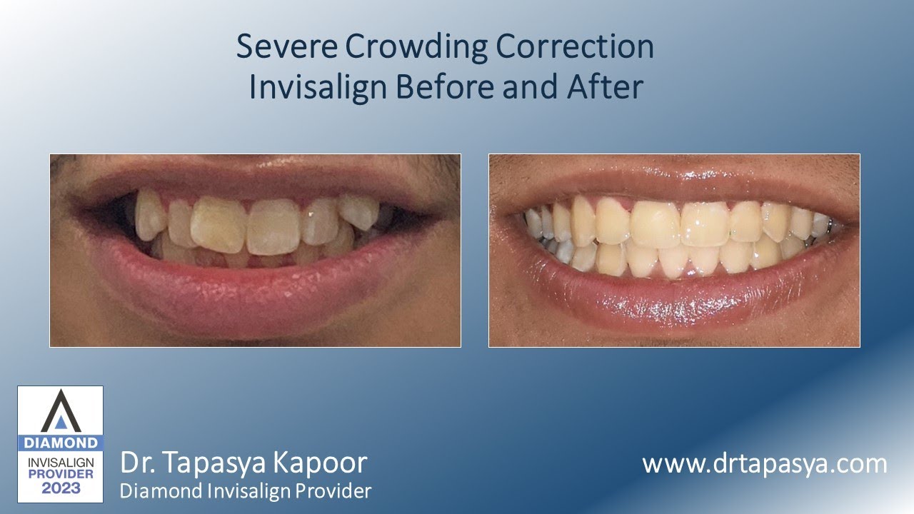 Severe Crowding Correction Invisalign Before And After YouTube Severe Crowding Correction Invisalign Before And After YouTube
